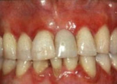 جرم دندان چیست؟